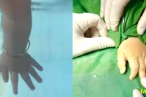 Cắt ngón tay thừa giúp trẻ tự tin phát triển toàn diện