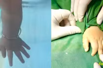 Cắt ngón tay thừa giúp trẻ tự tin phát triển toàn diện