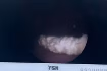 Bỏ quên ống sonde JJ 3 năm, vô tình trở thành “giá đỡ” cho sỏi bám