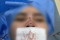 Cô gái 25 tuổi ở Hà Nội bị thủng mũi sau 3 tháng căng chỉ nâng mũi