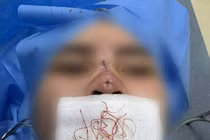 Cô gái 25 tuổi ở Hà Nội bị thủng mũi sau 3 tháng căng chỉ nâng mũi