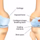 Phát hiện thuốc chống động kinh giúp phục hồi sụn khớp hiệu quả hơn