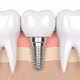 Hạt titan từ răng implant có thể kích hoạt viêm kéo dài