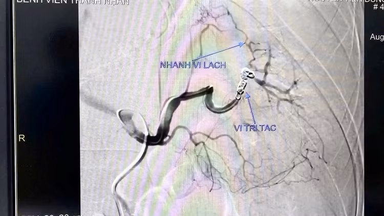 Hình ảnh chụp động mạch lách của bệnh nhân. Ảnh BV