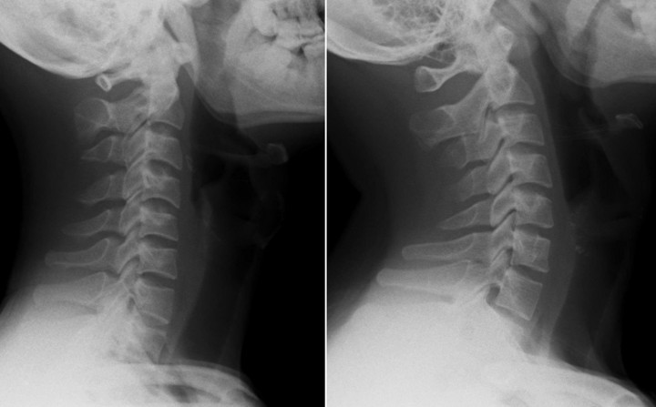 Cột sống cổ của nam thanh niên thẳng đứng (ảnh 1) và cột sống cổ bình thường (ảnh 2). (Ảnh: BSCC)