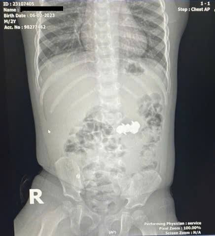 Bé trai nuốt 4 viên đinh nam châm đầu nhọn nguy hiểm. Ảnh BV