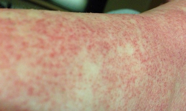 Sốt xuất huyết Dengue không phải lúc nào cũng biểu hiện bằng sốt cao hay xuất huyết - Ảnh minh họa