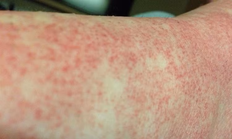 Sốt xuất huyết Dengue không phải lúc nào cũng biểu hiện bằng sốt cao hay xuất huyết - Ảnh minh họa