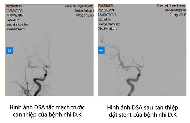 Hình ảnh chụp mạch máu số hóa xóa nền (DSA) của bệnh nhi ĐK. Ảnh BV