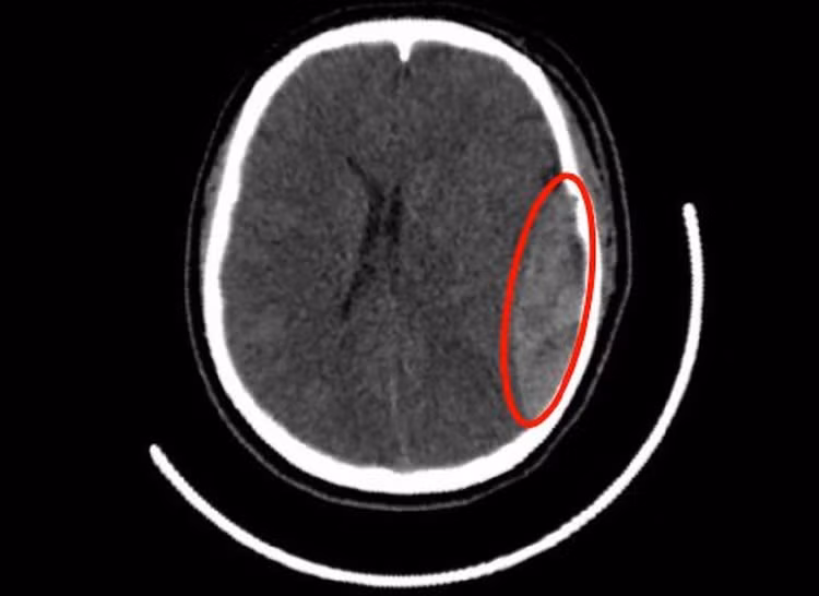 Hình ảnh kiểm tra ghi nhận vị trí nứt hộp sọ, máu tụ dưới màng cứng nữ sinh gặp phải/Ảnh tienphong.vn