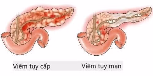 Viêm tụy có hai dạng viêm tụy cấp và viêm tụy mạn tính/ Ảnh benhvienthucuc.vn