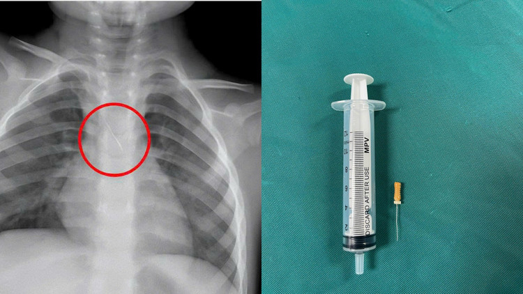 Dị vật trong đường thở của bệnh nhi. Ảnh BV