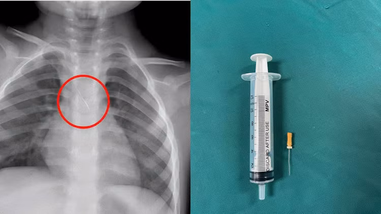 Dị vật trong đường thở của bệnh nhi. Ảnh BV
