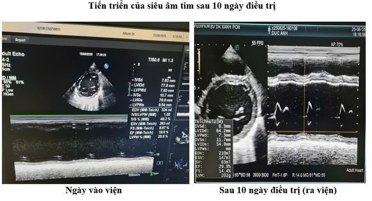 Tiến triển của siêu âm tim phổi sau 10 ngày điều trị. Ảnh BV