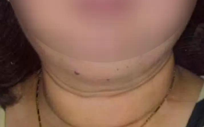 Bệnh nhân đến khám trong tình trạng mặt tròn, tăng cân bất thường.