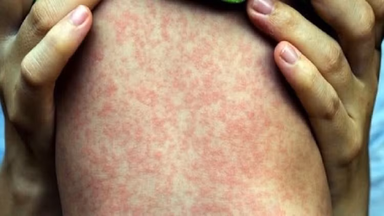 Cách phòng ngừa hiệu quả nhất là tiêm vắc-xin sởi, và điều trị chủ yếu là chăm sóc triệu chứng (hạ sốt, giảm ho, bổ sung nước, dinh dưỡng). Ảnh minh họa/Internet