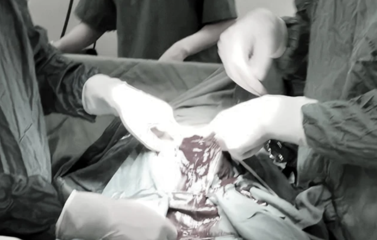 Ê-kíp phẫu thuật buộc phải cắt tử cung bán phần để cứu sống bệnh nhân. Ảnh PLXH.