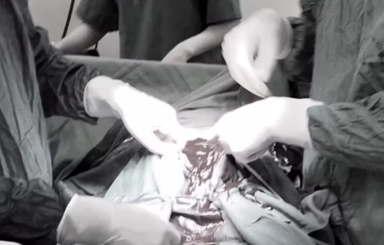 Ê-kíp phẫu thuật buộc phải cắt tử cung bán phần để cứu sống bệnh nhân. Ảnh PLXH.