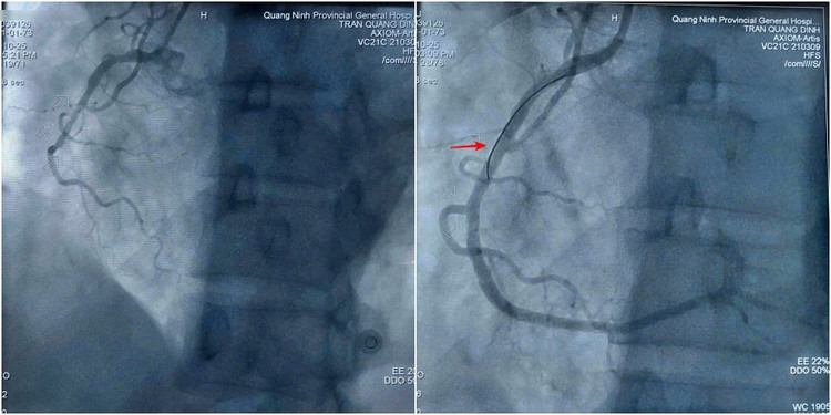 Hình ảnh trước và sau can thiệp đặt stent tái thông mạch vành cho bệnh nhân Q. Ảnh BV