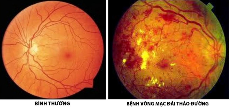 Bệnh võng mạc tiểu đường là biến chứng nguy hiểm của bệnh tiểu đường/ Ảnh minh hoạ/Internet