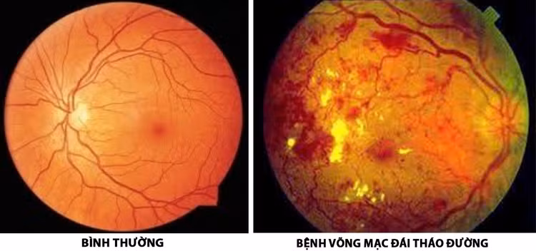 Bệnh võng mạc tiểu đường là biến chứng nguy hiểm của bệnh tiểu đường/ Ảnh minh hoạ/Internet