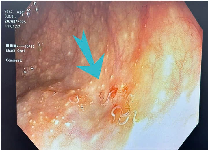 Hình ảnh giun trong đại tràng của người bệnh/Ảnh Bệnh viện Việt Nam – Thụy Điển Uông Bí