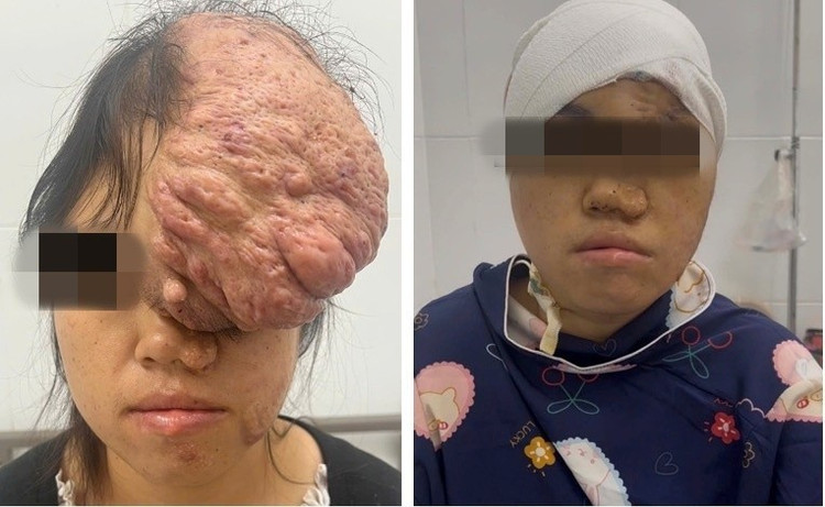 Hình ảnh gương mặt bệnh nhân trước và sau phẫu thuật