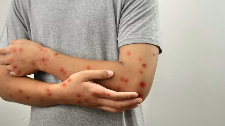 Bệnh đậu mùa khỉ gây xuất hiện của các mẩn đỏ trên da. Ảnh minh họa/Internet