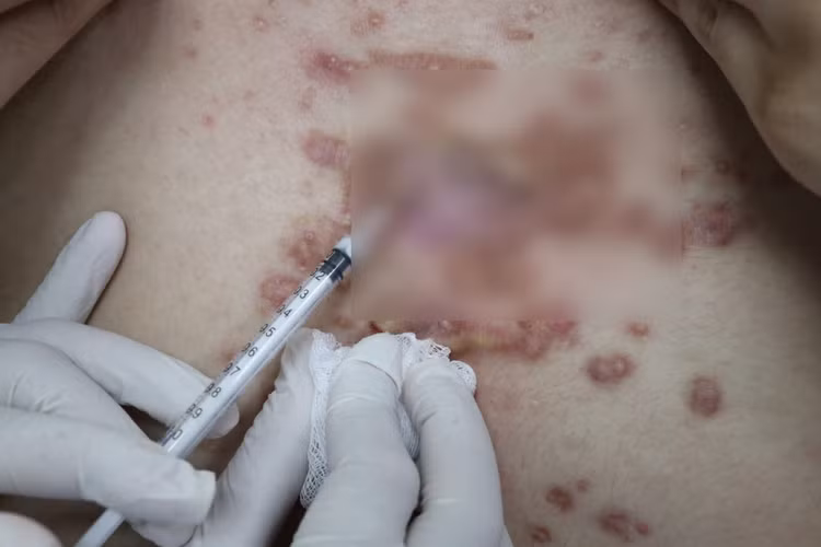 Bệnh viện Da Liễu TP HCM thường xuyên tiếp nhận người bệnh bị biến chứng khi làm đẹp ở cơ sở không uy tín. Ảnh: BV