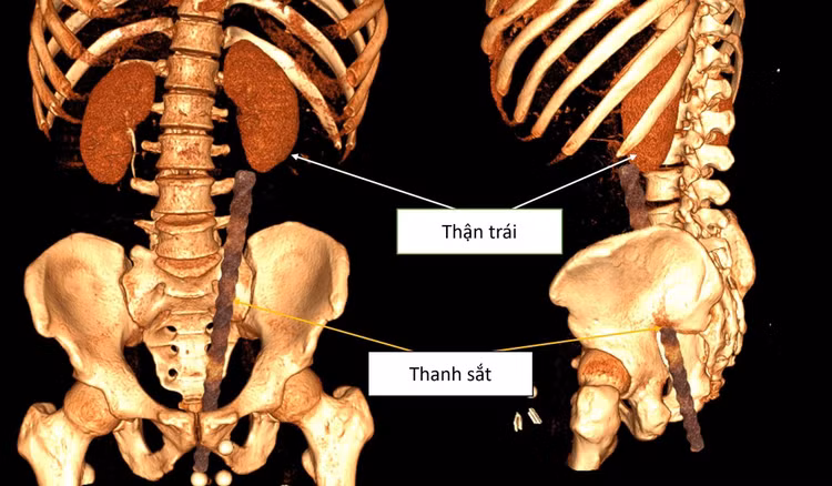 Hình ảnh dị vật xuyên qua lỗ hậu môn với độ sâu khoảng 30cm.