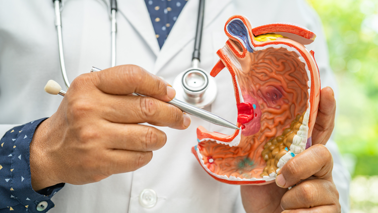 Phát hiện dấu hiệu ung thư dạ dày sớm giúp điều trị hiệu quả hơn. Ảnh minh hoạ/Internet