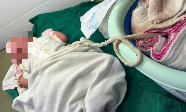 Trẻ nhập viện trong tình trạng còn nguyên bánh nhau. Ảnh: TTYT Cẩm Mỹ.