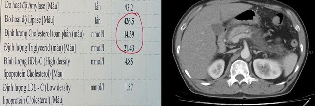 Kết quả xét nghiệm mỡ máu tăng rất cao (trái) và hình ảnh tổn thương viêm tụy cấp mức độ nặng trên phim CT ổ bụng của bệnh nhân (phải). Ảnh SKĐS