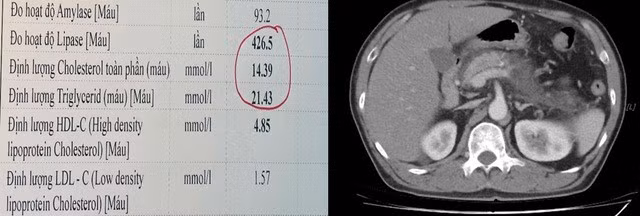 Kết quả xét nghiệm mỡ máu tăng rất cao (trái) và hình ảnh tổn thương viêm tụy cấp mức độ nặng trên phim CT ổ bụng của bệnh nhân (phải). Ảnh SKĐS