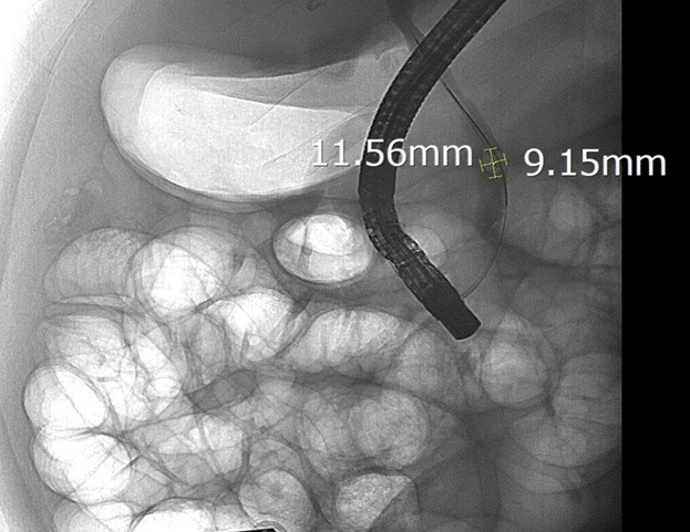 Sỏi ống mật chủ 'khủng' gây tắc mật nặng- Ảnh 2.