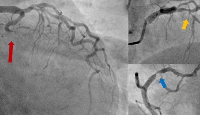 Hình ảnh chụp động mạch vành cho thấy tắc hoàn toàn động mạch mũ (mũi tên đỏ), hẹp nặng cả động mạch liên thất trước (mũi tên vàng) và động mạch vành phải (mũi tên xanh).