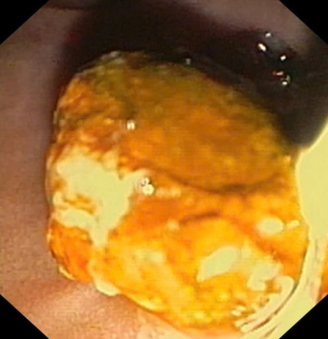 Sỏi ống mật chủ 'khủng' gây tắc mật nặng- Ảnh 4.