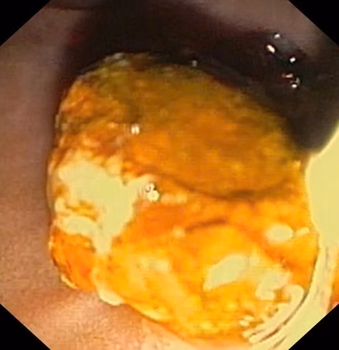 Sỏi ống mật chủ 'khủng' gây tắc mật nặng- Ảnh 4.