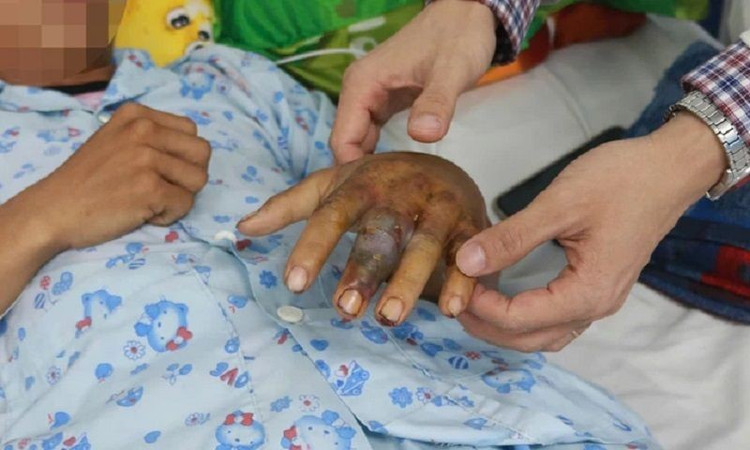 Bàn tay bị rắn cắn của bệnh nhân có dấu hiệu hoại tử/ Ảnh BV