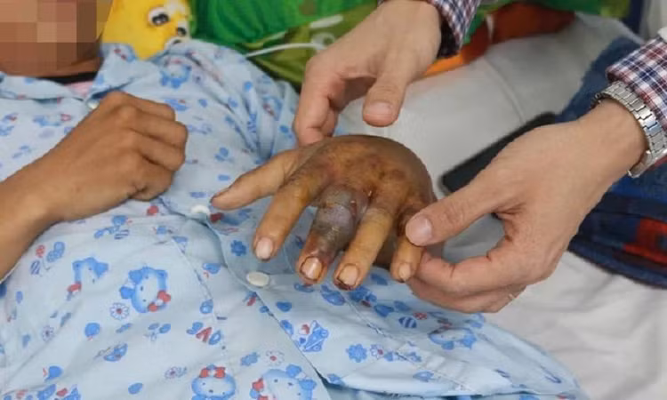 Bàn tay bị rắn cắn của bệnh nhân có dấu hiệu hoại tử/ Ảnh BV