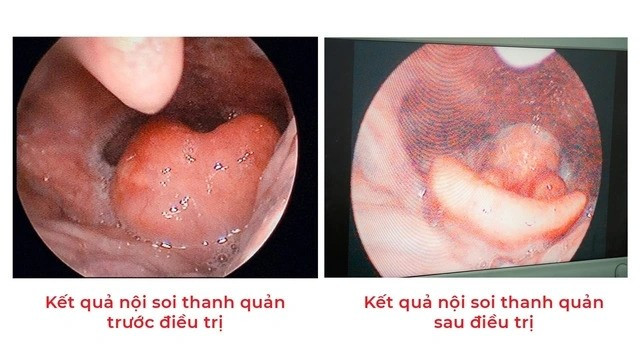 Kết quả nội soi của bệnh nhân. Ảnh BV/Nguồn TTTĐ