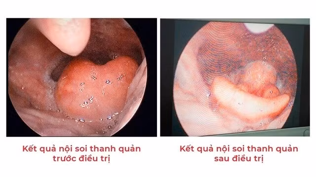 Kết quả nội soi của bệnh nhân. Ảnh BV/Nguồn TTTĐ