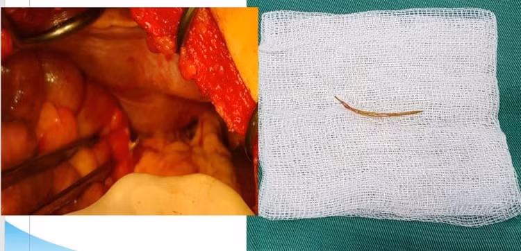 Hình ảnh dị vật xương cá đâm xuyên thành đại tràng bệnh nhân LBS. Ảnh BVCC