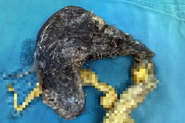 Búi tóc được lấy từ dạ dày của bệnh nhi 5 tuổi (Ảnh: Bệnh viện Đa khoa Ninh Thuận).