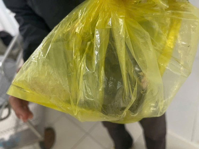 Con đỉa dài khoảng 8 cm chui vào niệu đạo một nam giới khi đang làm đồng. Ảnh: Bệnh viện Đa khoa Thống nhất Đồng Nai cung cấp