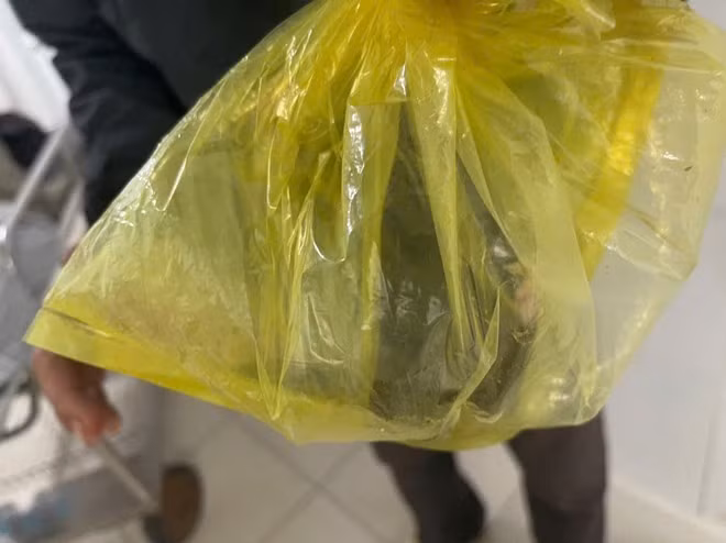 Con đỉa dài khoảng 8 cm chui vào niệu đạo một nam giới khi đang làm đồng. Ảnh: Bệnh viện Đa khoa Thống nhất Đồng Nai cung cấp