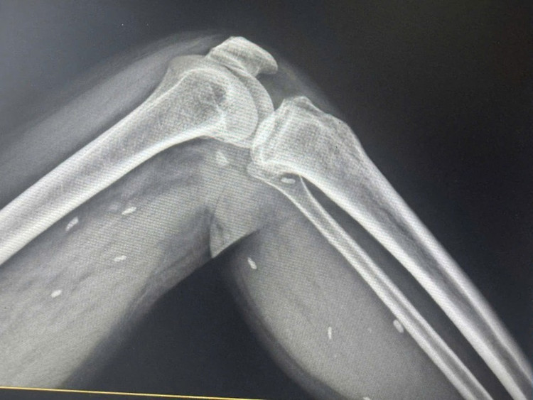 Nhiều kén sán nằm trong mô vùng xương đùi và cẳng chân bệnh nhân/Ảnh plo.vn