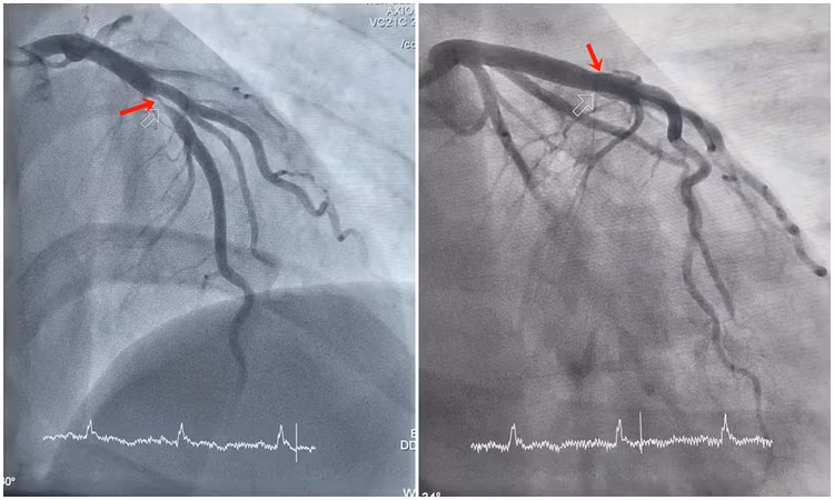 Hình ảnh hẹp tắc động mạch liên thất trước của bệnh nhân H. được can thiệp tái thông. Ảnh BV