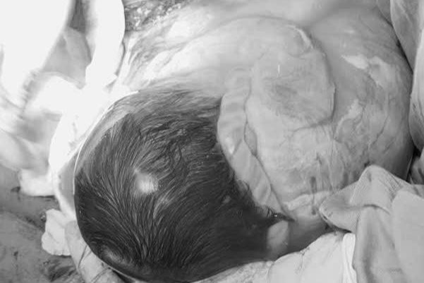 Em bé sinh trong &quot;bọc điều&quot; hiện tượng hiếm thấy. Ảnh: BVCC