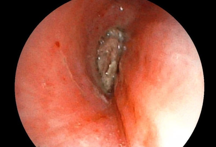 Hình ảnh dị vật góc cạnh khoảng 1cm là hạt kha tử hình bầu dục, gây bít tắc trong lòng phế quản. Ảnh BV